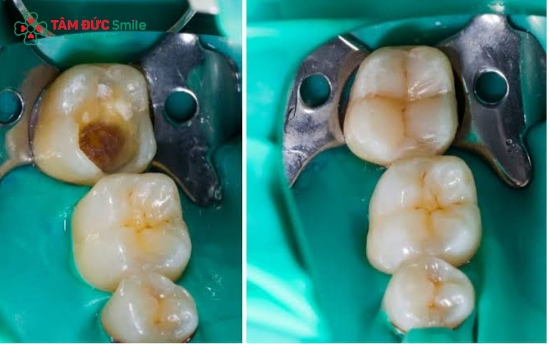 Việc phát hiện và trám răng ngay từ giai đoạn sâu men hoặc sâu ngà giúp bảo tồn mô răng tối đa và tiết kiệm chi phí điều trị cho người bệnh.