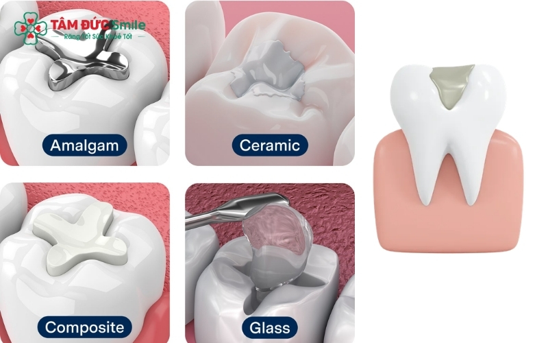 Trám răng bằng vật liệu Composite tại Nha khoa Tâm Đức Smile mang lại độ thẩm mỹ cao, màu sắc tự nhiên và khả năng chịu lực tốt trong ăn nhai hàng ngày.