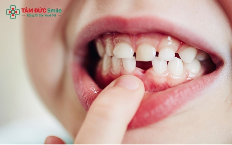 Giai đoạn mọc và thay răng là lúc cấu trúc hàm của trẻ biến đổi mạnh, đây là một trong những nguyên nhân khiến trẻ nghiến răng tạm thời.