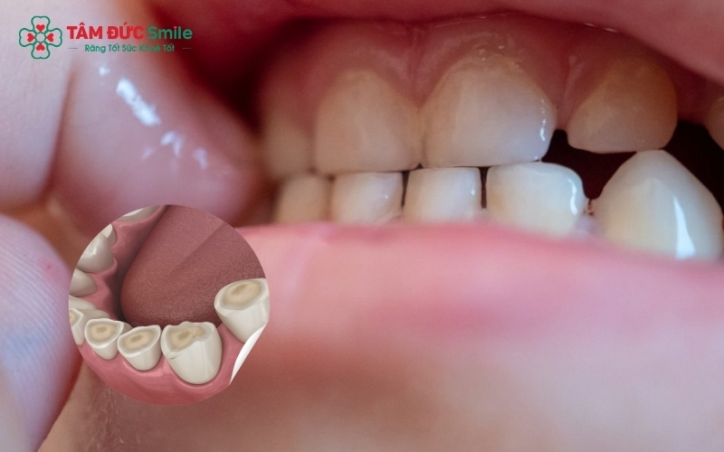 Nghiến răng kéo dài có thể gây mòn men răng, dẫn đến ê buốt và ảnh hưởng đến sự phát triển của hệ thống nhai.