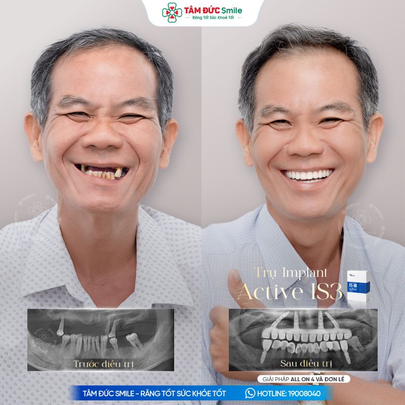 trong-rang-implant-2