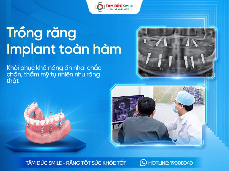 Trồng răng implant toàn hàm là gì? Phương pháp, Quy trình, Chi phí và Địa chỉ uy tín