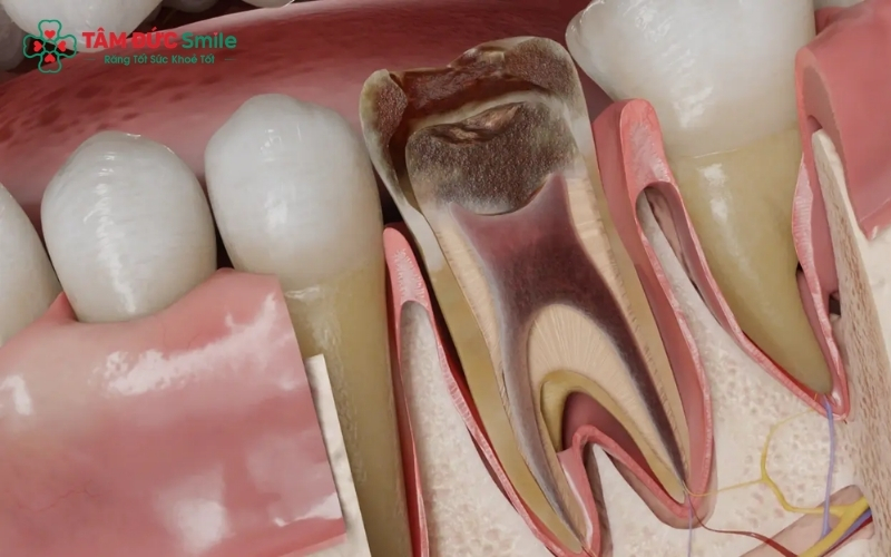 Viêm tủy răng nếu không được xử lý sớm sẽ tiến triển từ viêm có hồi phục sang không hồi phục, đe dọa trực tiếp đến cấu trúc răng thật.