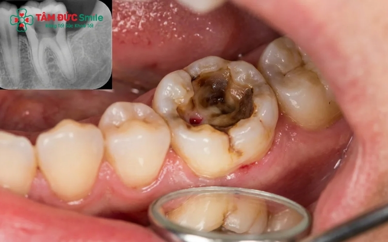 Viêm tủy răng kéo dài không điều trị có thể dẫn đến áp xe chân răng, tiêu xương và nguy cơ mất răng vĩnh viễn.