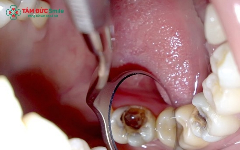 Đừng nhầm tưởng cơn đau giảm đi là bệnh đã khỏi; thực tế, tủy đã hoại tử vẫn âm thầm gây nhiễm trùng trong xương hàm.
