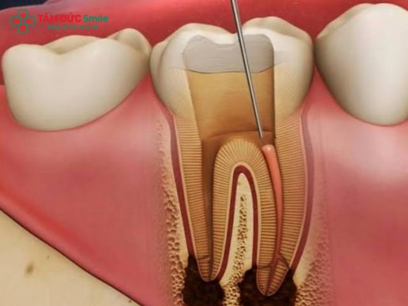 Viêm tủy răng có nguy hiểm không? Biến chứng và cách điều trị