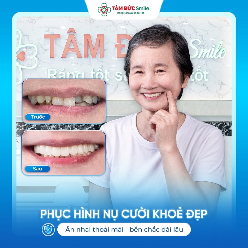 Trồng răng Implant giúp phục hồi răng mất, cải thiện khả năng ăn nhai.