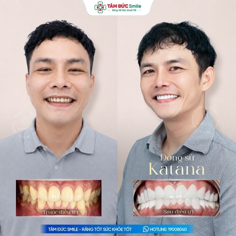 Kết quả bọc răng sứ thẩm mỹ giúp nụ cười đều đẹp, tự nhiên