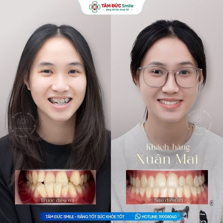 Khách hàng cải thiện tình trạng răng lệch lạc sau niềng răng tại Tâm Đức Smile