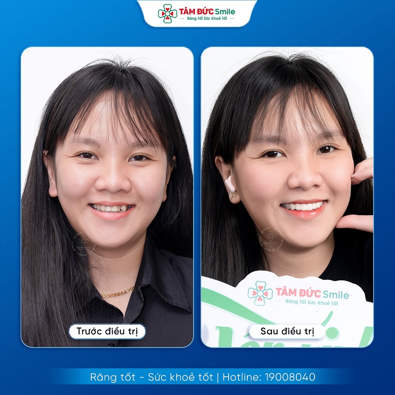 Niềng răng giúp cải thiện răng lệch lạc, hô, móm và sai khớp cắn