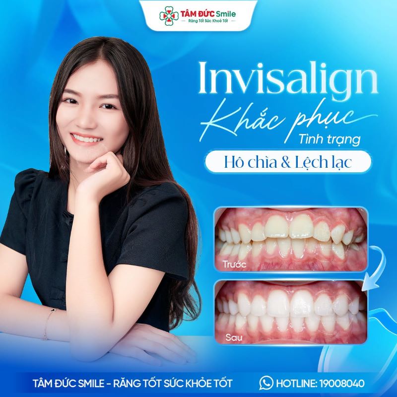 Kết quả niềng răng Invisalign hỗ trợ cải thiện tình trạng răng hô chìa, lệch lạc tại Nha khoa Tâm Đức Smile