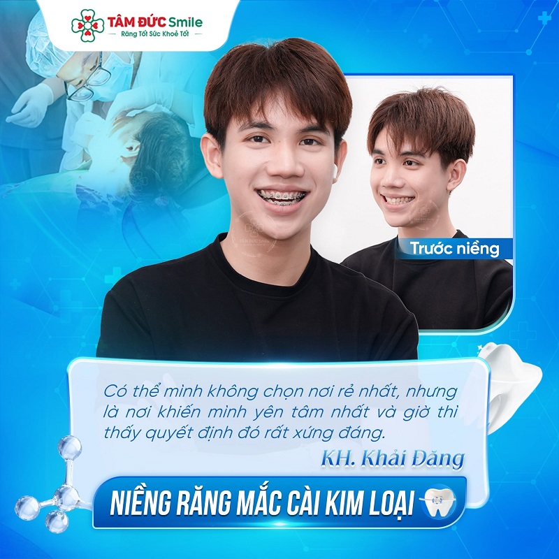 Niềng răng mắc cài giúp cải thiện lệch lạc và nâng cao thẩm mỹ nụ cười.