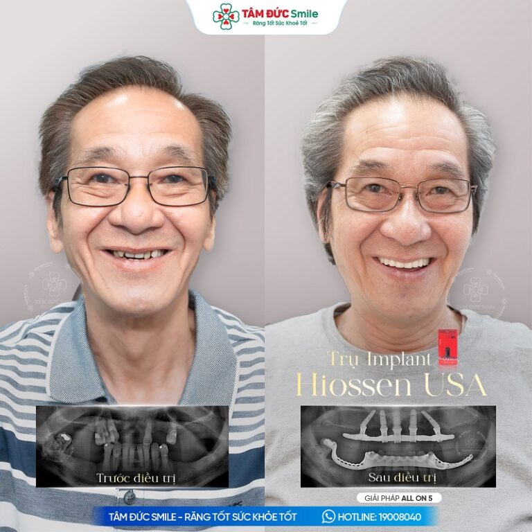 Khách hàng phục hồi răng toàn hàm bằng phương pháp cấy ghép Implant tại Nha khoa Tâm Đức Smile.