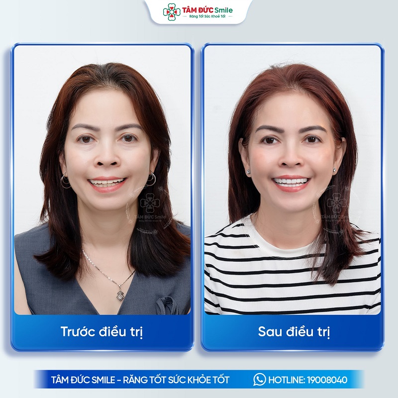 Hình ảnh trước và sau bọc răng sứ thẩm mỹ tại Nha khoa Tâm Đức Smile.