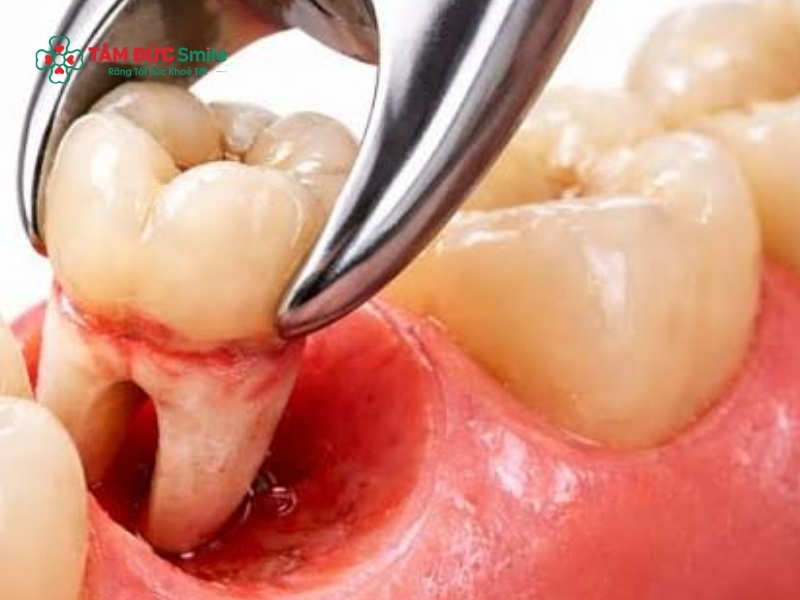 Dù độ tuổi phổ biến mọc răng khôn là từ 17-25, nhưng trẻ 14 tuổi vẫn có thể bắt đầu quá trình mọc răng khôn do sự phát triển sớm của cơ thể.