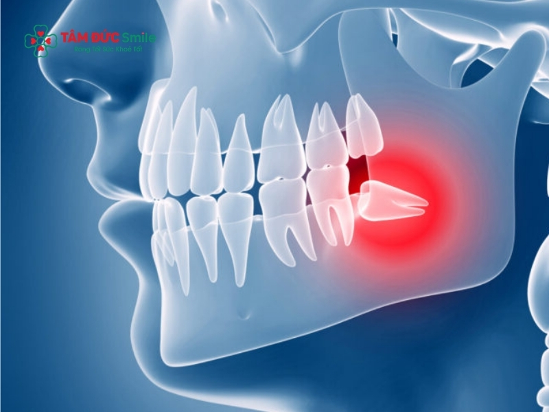 Dấu hiệu nhận biết rõ nhất là vùng nướu trong cùng sưng đỏ, gây cảm giác đau nhức âm ỉ, đặc biệt là khi trẻ nhai hoặc nuốt.