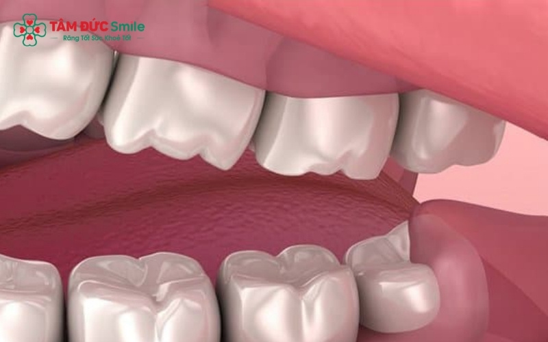 Dù chỉ mới 14 tuổi, răng khôn mọc lệch có thể âm thầm đâm vào răng số 7, gây hỏng chân răng và làm xô lệch toàn hàm.