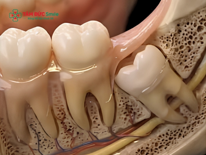 14 tuổi mọc răng khôn có sao không? Dấu hiệu và cách xử lý an toàn