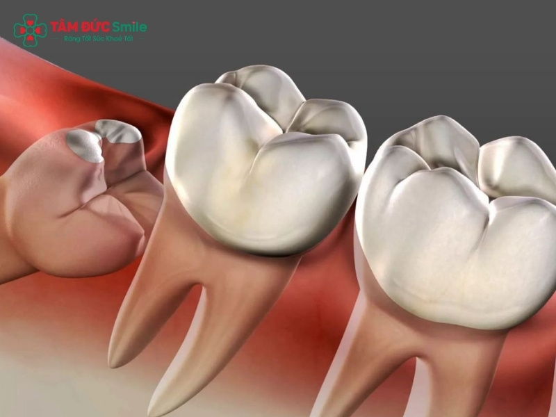 14 tuổi mọc răng khôn có nguy hiểm không?