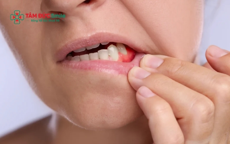 ùng nướu quanh răng số 8 sưng tấy, xuất hiện khối áp xe chứa mủ là dấu hiệu cảnh báo tình trạng nhiễm trùng đang tiến triển.