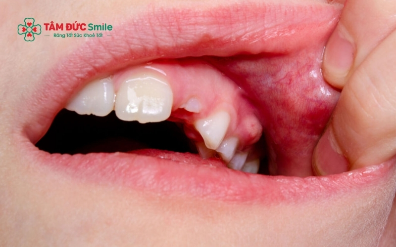 Ổ áp xe phá hủy xương hàm và đe dọa trực tiếp đến sức khỏe của răng số 7 kế cận