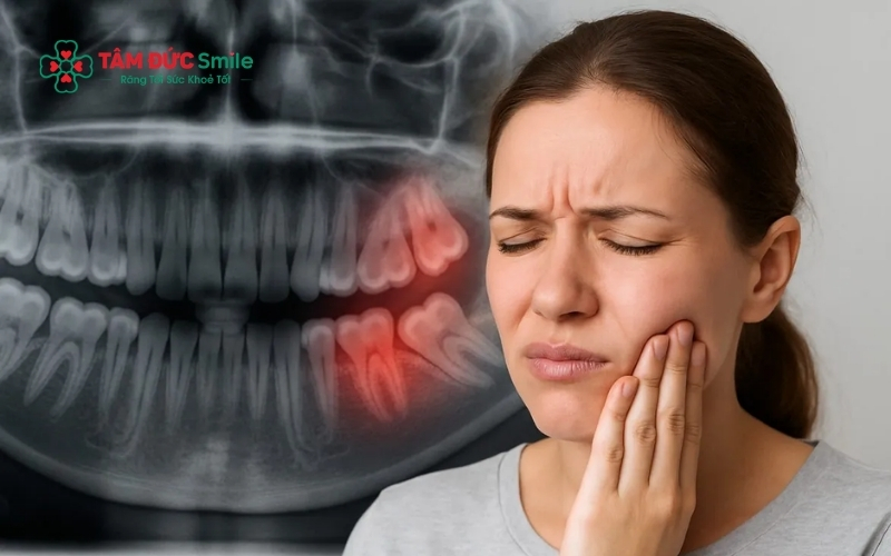 Các tư thế mọc lệch, mọc ngang của răng số 8 thường là thủ phạm chính gây ra những cơn đau nhức dữ dội và âm ỉ.