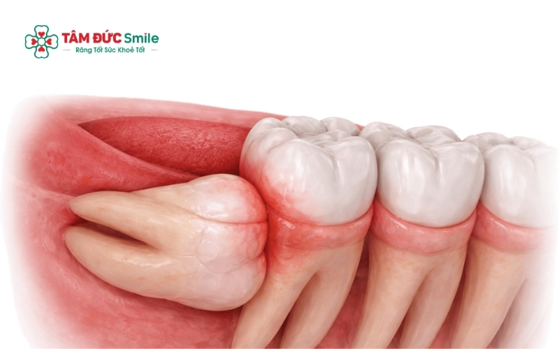 Nếu đau răng số 8 kèm theo sưng mặt hoặc khó há miệng, bạn cần đến nha khoa ngay lập tức để tránh nhiễm trùng lan rộng.