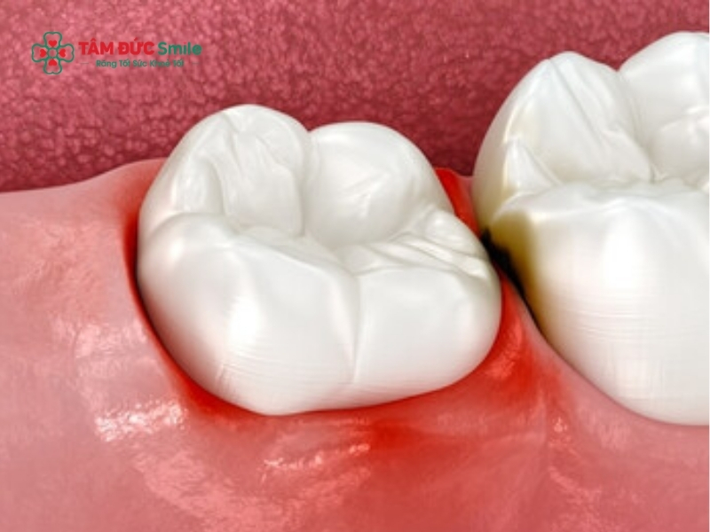 Cách chữa đau răng số 8 an toàn