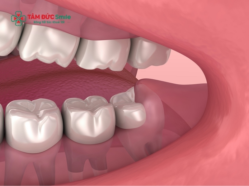 Các biện pháp tại nhà chỉ thực sự hiệu quả và an toàn khi cơn đau răng khôn ở mức độ nhẹ, chưa có dấu hiệu nhiễm trùng nghiêm trọng.