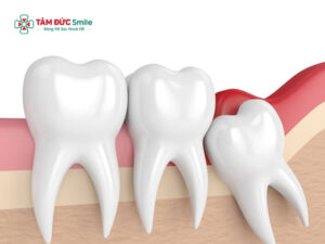 Cách giảm đau khi mọc răng khôn tại nhà an toàn, nhanh