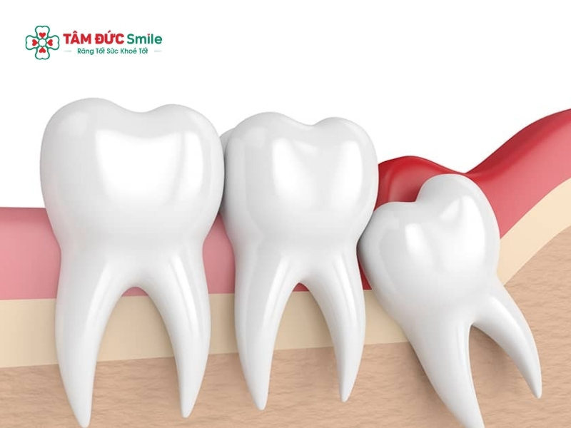Cách giảm đau khi mọc răng khôn tại nhà an toàn, nhanh