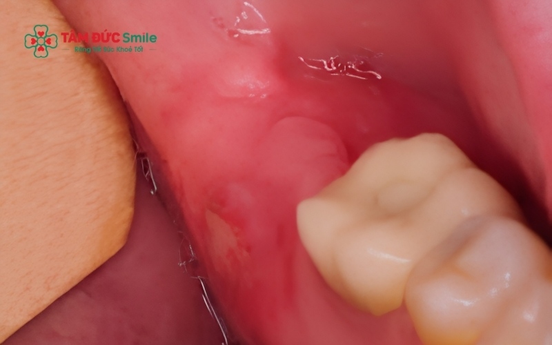 Trong 24 giờ đầu, quan trọng nhất là cắn gạc để cầm máu và tuyệt đối không súc miệng mạnh làm ảnh hưởng đến quá trình hình thành cục máu đông