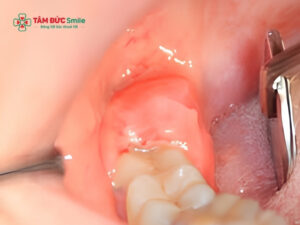 Cách vệ sinh sau khi nhổ răng số 8 giúp nhanh lành