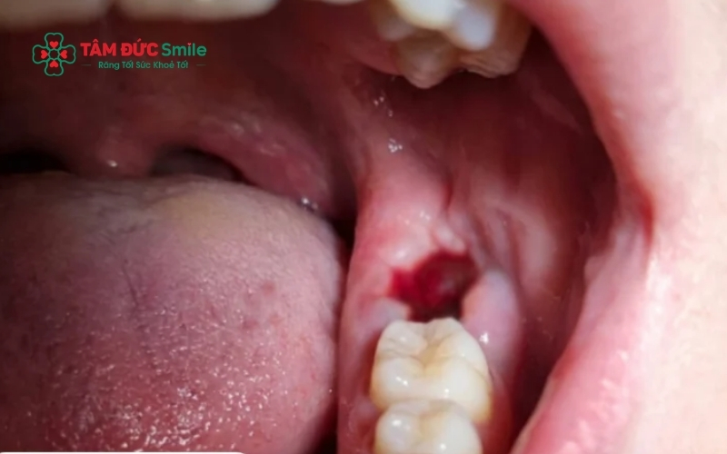 Hiện tượng rỉ máu nhẹ khiến nước bọt có màu hồng nhạt trong 24 giờ đầu là hoàn toàn bình thường và không đáng lo ngại.