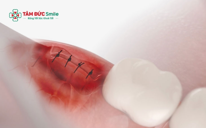 Nắm vững các mốc thời gian phục hồi giúp bạn chủ động theo dõi tình trạng sức khỏe răng miệng sau khi nhổ răng khôn