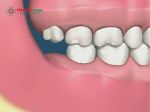 Chảy máu sau khi nhổ răng số 8 bao lâu hết và cách cầm máu