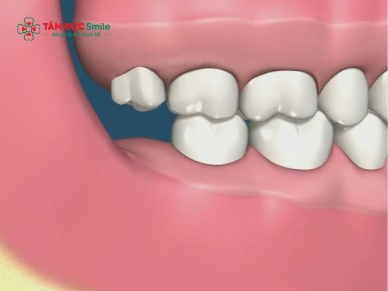 Chảy máu sau khi nhổ răng số 8 bao lâu hết và cách cầm máu