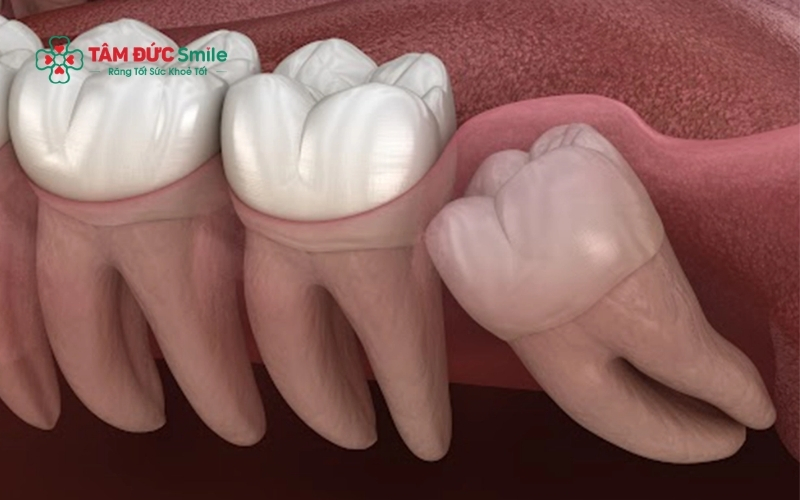 Các tư thế mọc lệch, mọc ngang của răng số 8 là nguyên nhân chính gây ra những cơn đau nhức dữ dội và kéo dài.