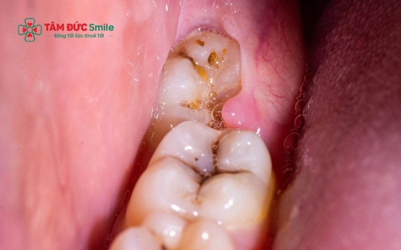 Răng số 8 mọc lệch không chỉ gây đau mà còn có nguy cơ "tiêu diệt" răng số 7 – chiếc răng ăn nhai quan trọng trên cung hàm.