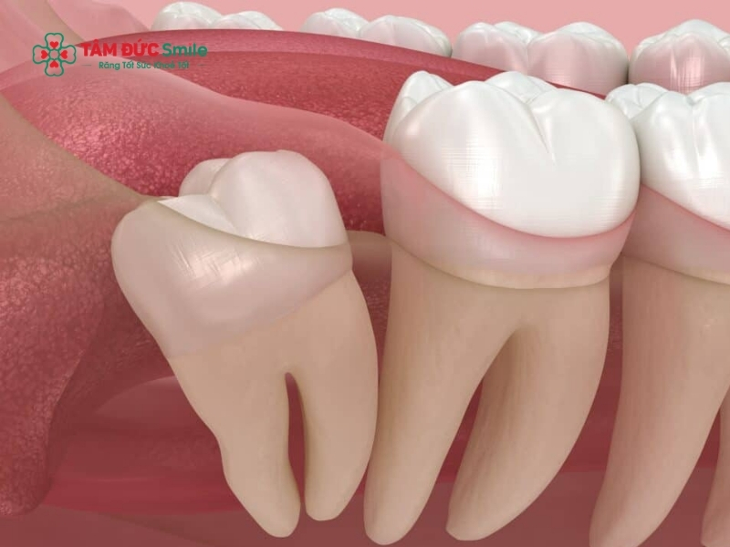 Quy trình nhổ răng số 8 tại nha khoa chuẩn y khoa giúp hạn chế biến chứng