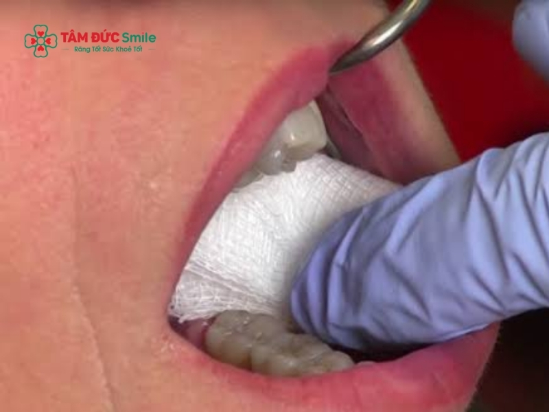 Cắn gạc đúng cách để cầm máu là "bí kíp" giúp giảm sưng và giảm cảm giác ê buốt hiệu quả