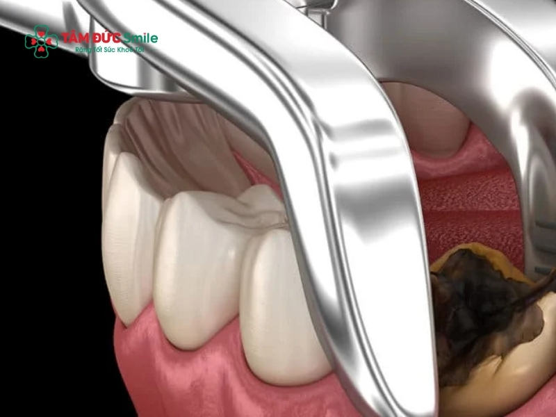 Kinh nghiệm nhổ răng số 8: Trước, trong và sau khi nhổ cần biết