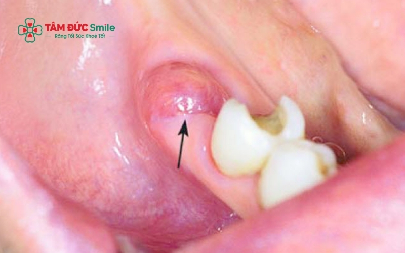 Vạt lợi trùm lên răng số 8 tạo thành "bẫy thức ăn", khiến vi khuẩn tích tụ và gây viêm nhiễm kéo dài.Vạt lợi trùm lên răng số 8 tạo thành "bẫy thức ăn", khiến vi khuẩn tích tụ và gây viêm nhiễm kéo dài.