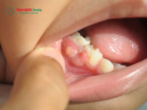Viêm lợi trùm răng số 8: Nguyên nhân, dấu Hiệu và cách điều trị