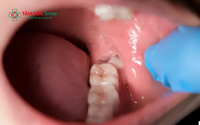 Độ khó của răng (mọc lệch, ngầm) và kỹ thuật của bác sĩ là những yếu tố then chốt quyết định thời gian lành thương của mỗi người.