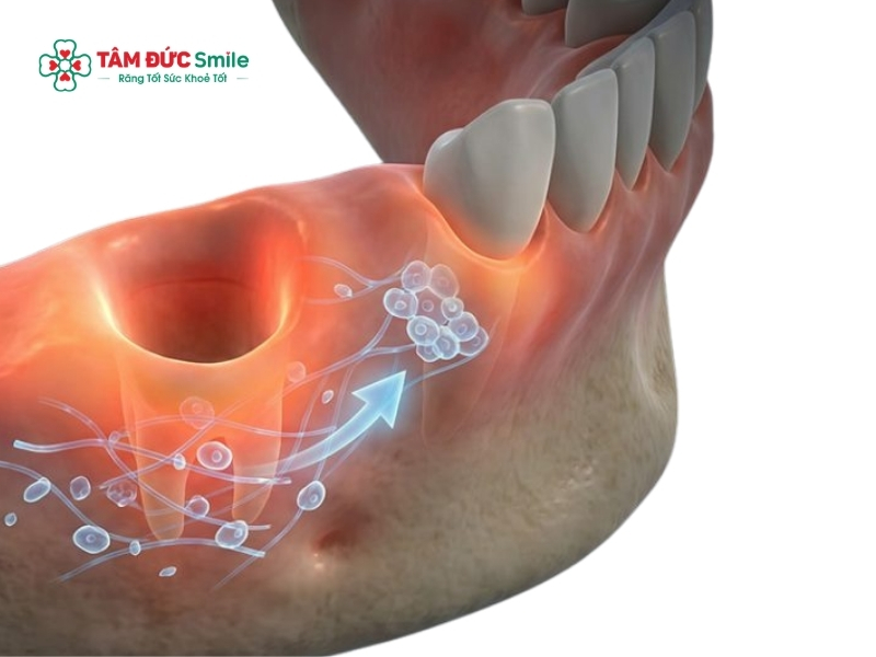 Nhổ răng số 8 bao lâu thì lành? Cách chăm sóc nhanh hồi phục