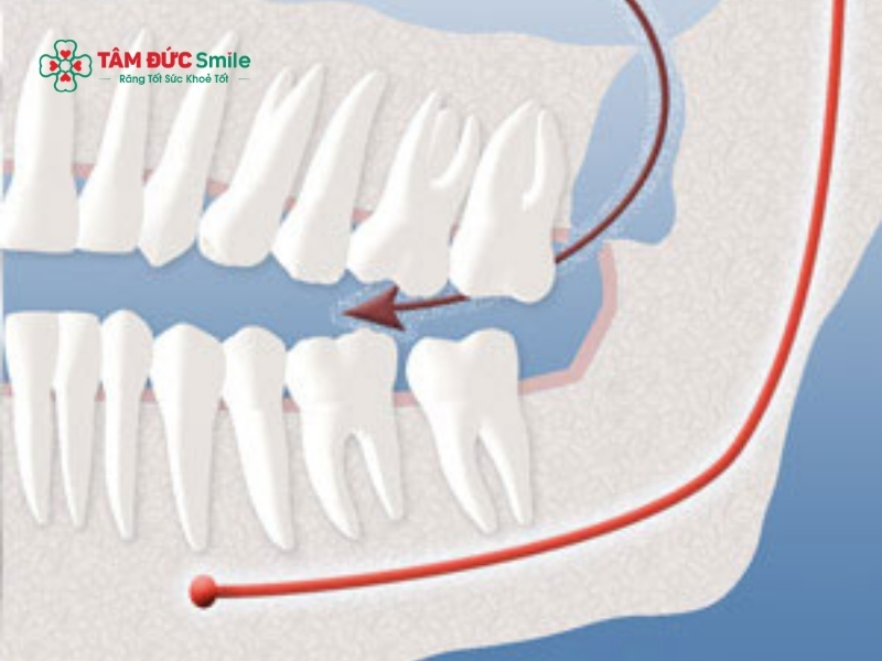 Sự thay đổi kích thước khuôn mặt chủ yếu là do tình trạng sưng viêm biến mất, khiến bạn có cảm giác má bị "gầy" đi so với lúc đang sưng.