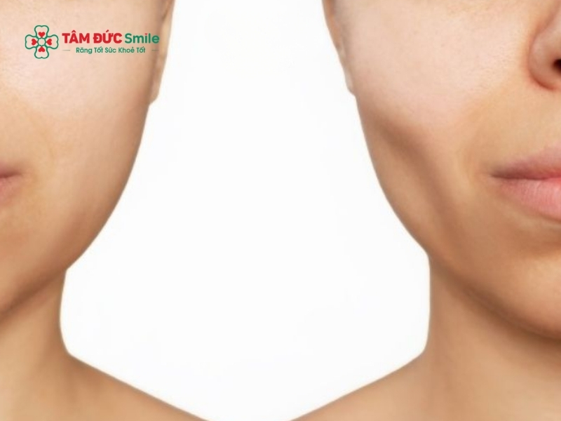 Việc mất răng số 8 đơn thuần không gây tiêu xương hàm diện rộng hay hóp má