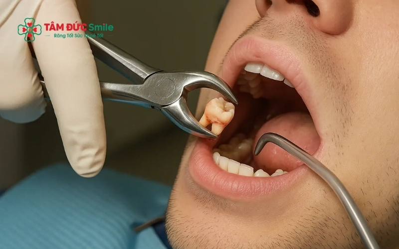 Với công nghệ gây tê hiện đại và máy siêu âm Piezotome, quá trình nhổ răng số 8 diễn ra vô cùng nhẹ nhàng, khách hàng hầu như không cảm thấy đau đớn.