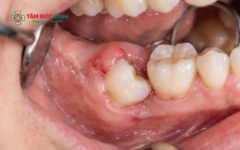 Răng số 8 thường có chân răng phức tạp và nằm sát dây thần kinh, do đó việc nhổ bỏ đòi hỏi kỹ thuật cao hơn so với các răng thông thường.